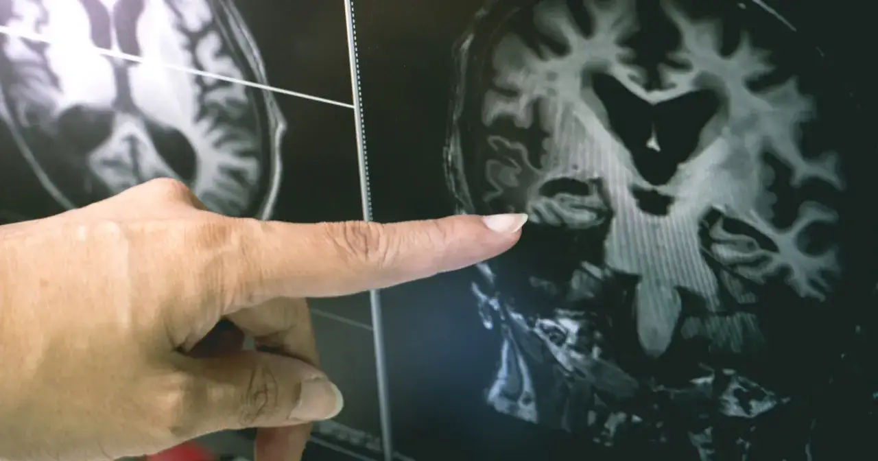 Palec wskazuje na obraz mózgu, sugerując niedobór witaminy D i jego objawy neurologiczne.
