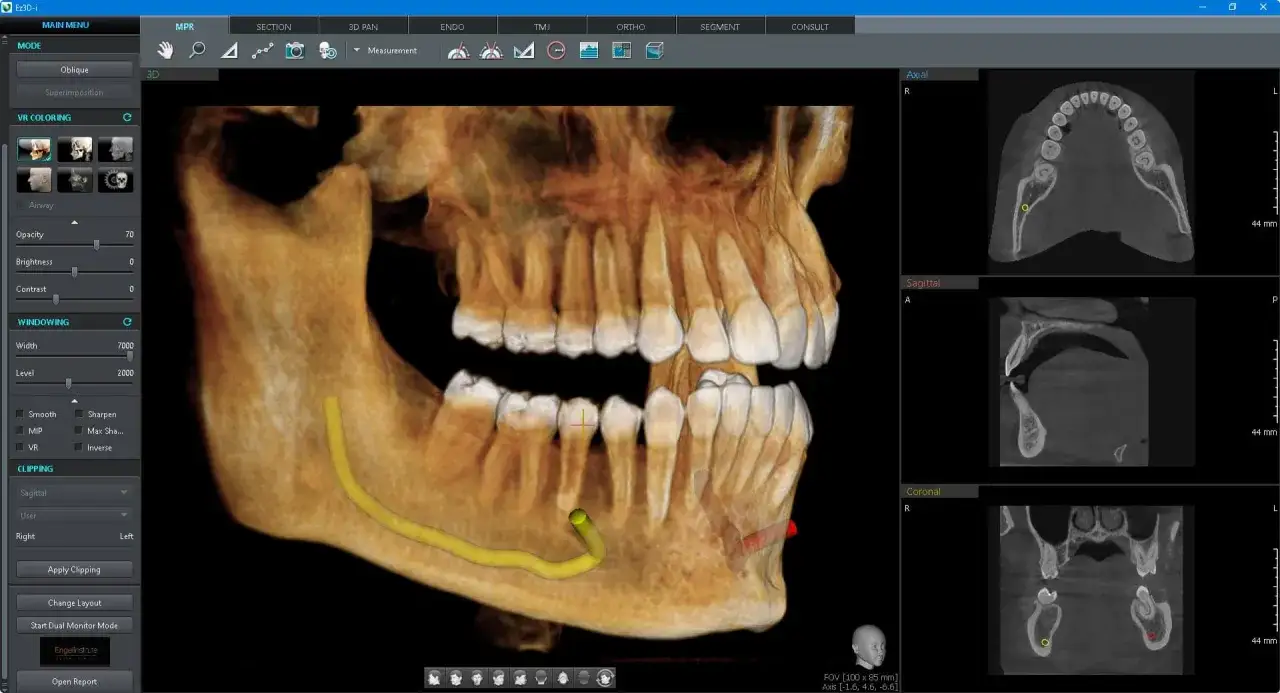 CBCT co to? Trójwymiarowy obraz szczęki i żuchwy z zaznaczonym nerwem. Widoczne przekroje osiowe, strzałkowe i wieńcowe.