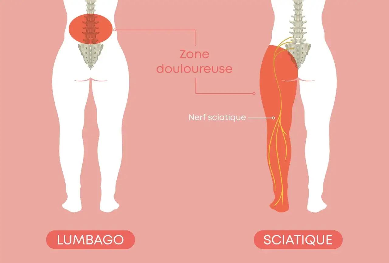 Illustration comparant le lumbago et la sciatique. La sciatique affecte le nerf sciatique, causant une douleur irradiant de la hanche jusqu'au pied.