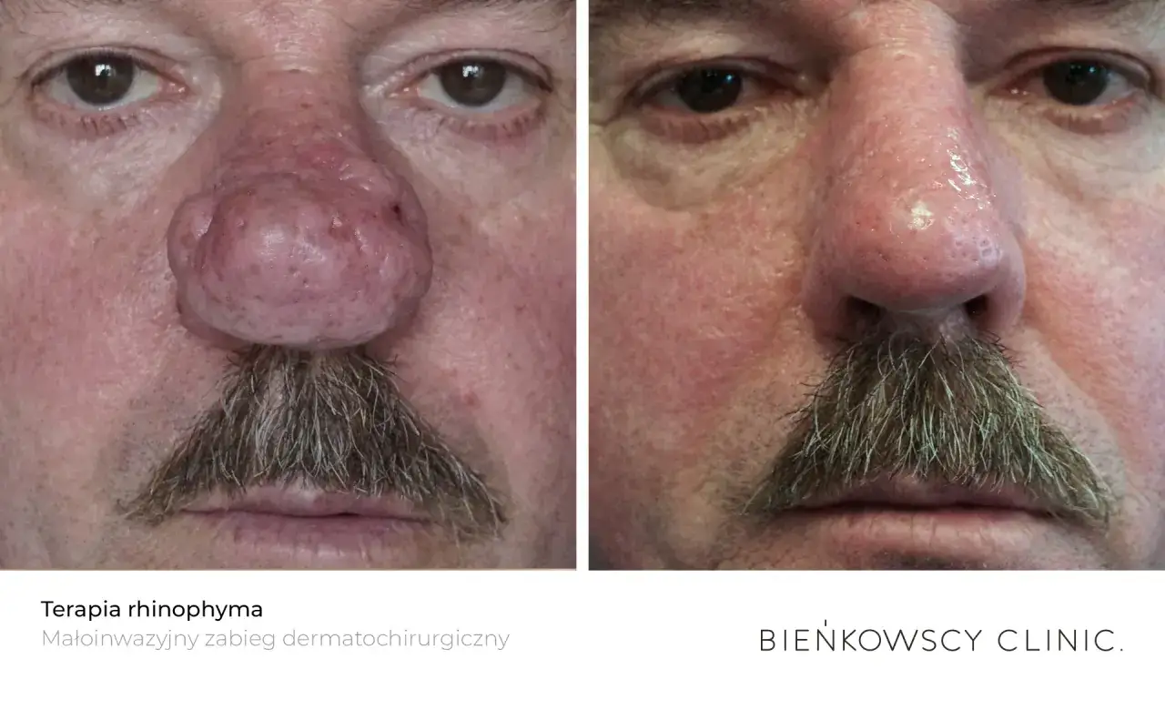 Przed i po terapii rhinophyma: widoczna znacząca redukcja przerostu skóry na nosie, który wcześniej tworzył dużą narośl.