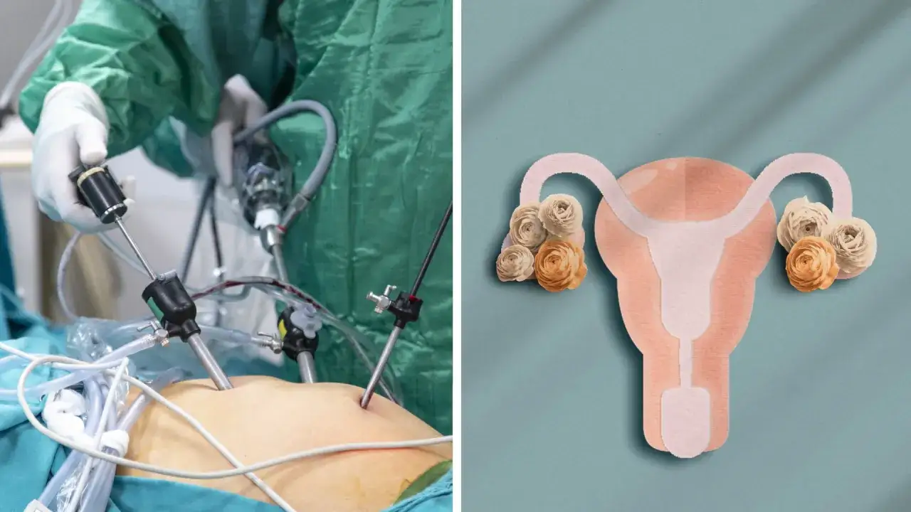 Kirurgiska instrument anv&auml;nds vid en laparoskopi, en behandling f&ouml;r pcos symptom. Till h&ouml;ger syns en illustration av livmodern med &auml;ggstockar.