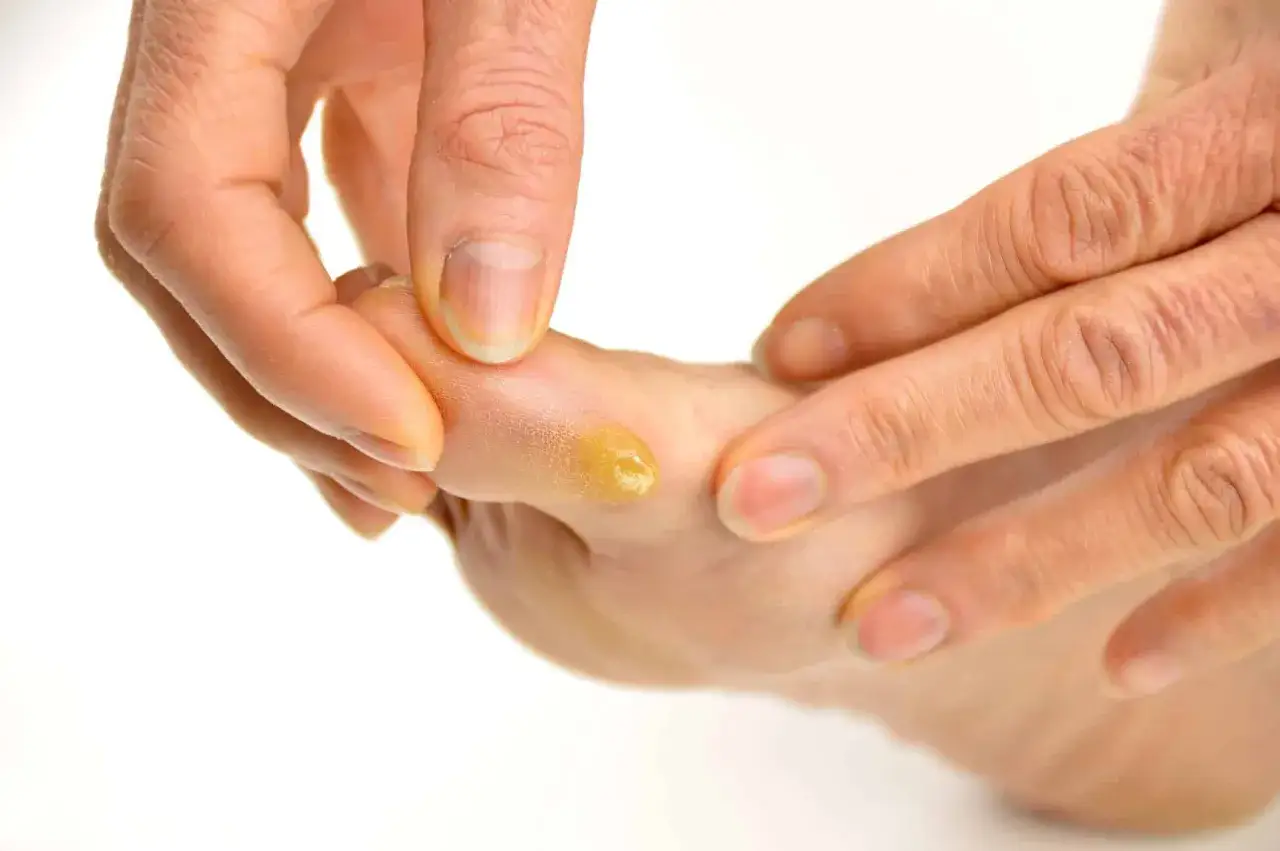 Dedos examinando un callo amarillo y doloroso en el dedo del pie.