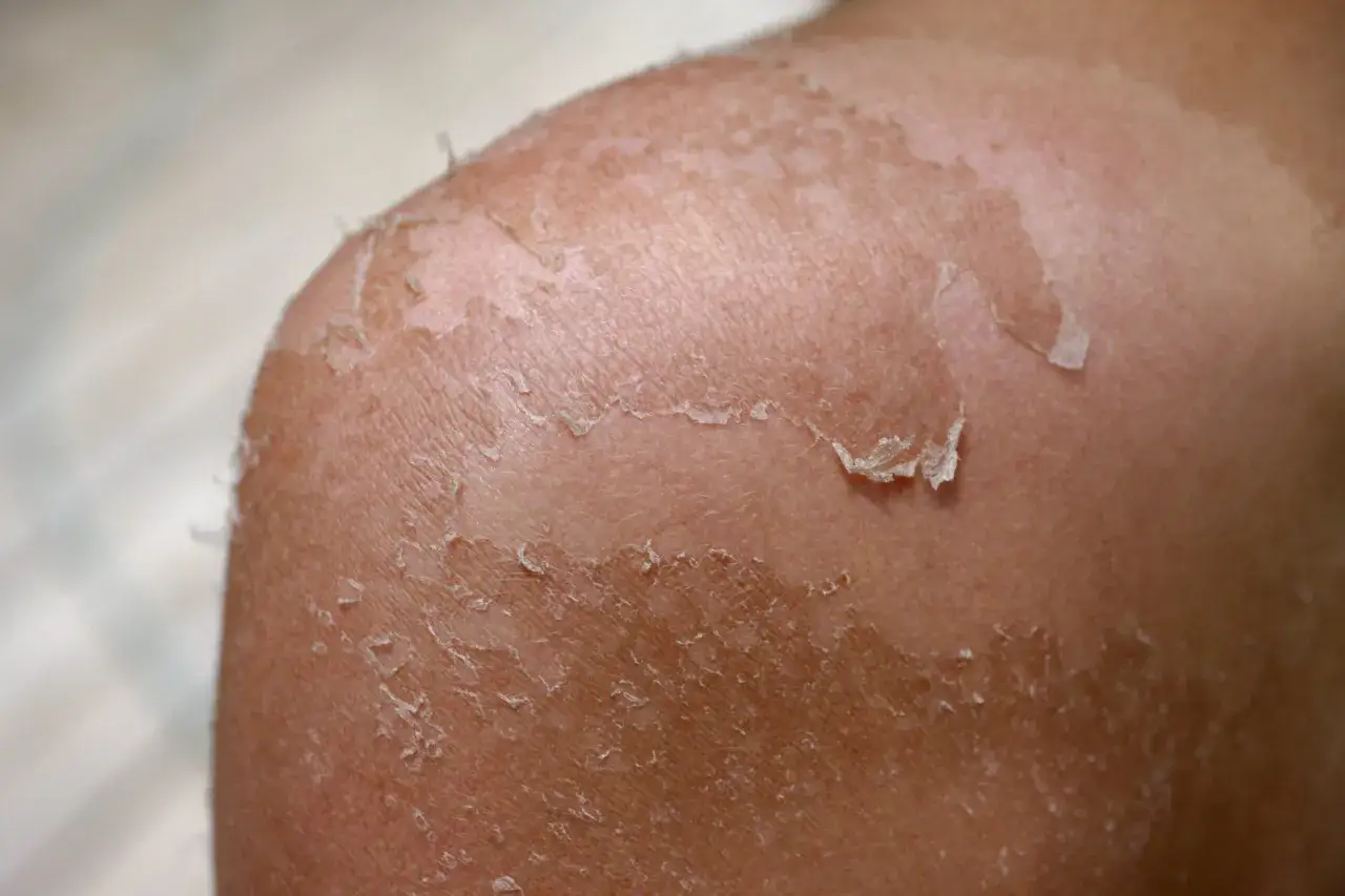 Haut sch&auml;lt sich nach starkem Sonnenbrand. Kleine Brandblasen sind sichtbar, die Haut ist ger&ouml;tet und gereizt.