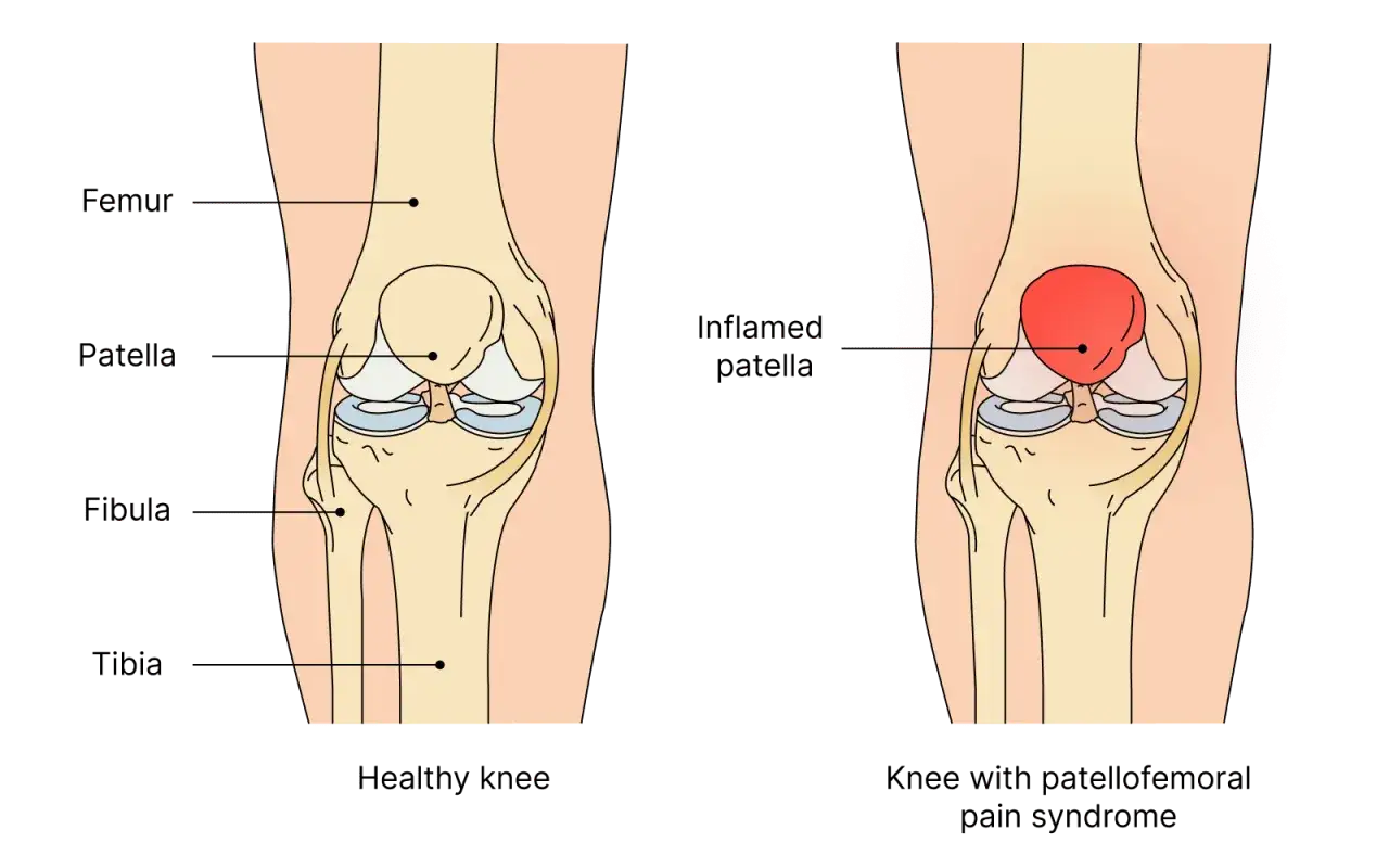 Comparaison d'un genou sain et d'un genou avec syndrome douloureux f&eacute;moro-patellaire, montrant une rotule enflamm&eacute;e.