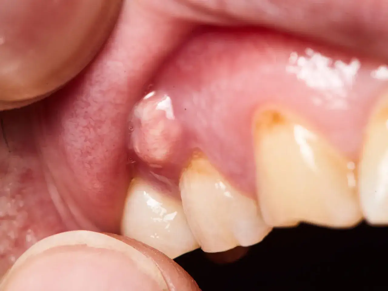Gengiva gonfia con pus vicino a un dente incapsulato, possibile infezione dente sotto capsula sintomi.