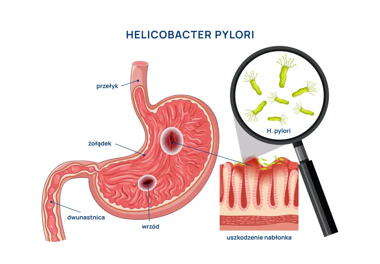 Helicobacter pylori powoduje wrzody żołądka i dwunastnicy, uszkadzając nabłonek. Objawy jelitowe mogą być uciążliwe.