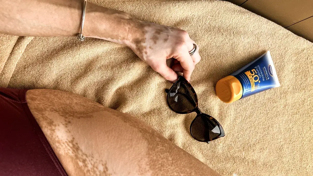 Dłoń z bielactwem nabytym sięga po okulary przeciwsłoneczne obok kremu z filtrem SPF 50.