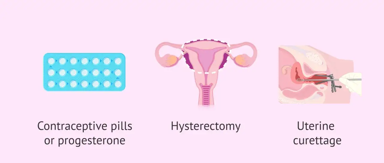 Pastillas anticonceptivas, histerectom&iacute;a y legrado uterino: tratamientos para la hiperplasia endometrial.