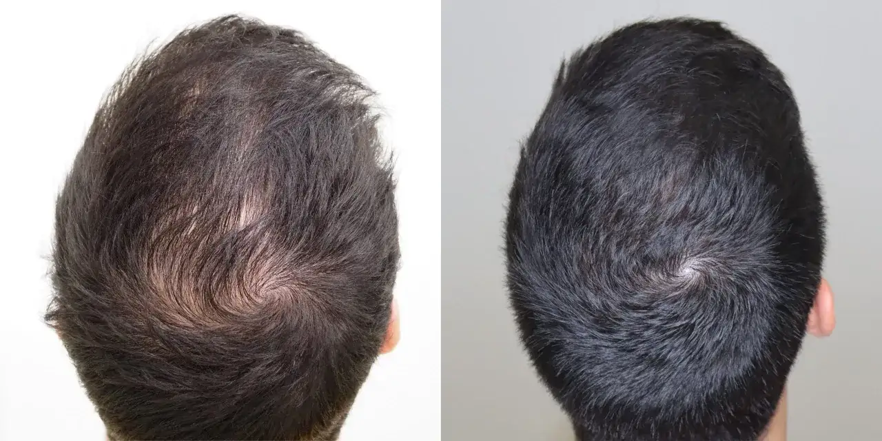 Comparativa de mesoterapia capilar antes y despu&eacute;s: cabello m&aacute;s denso y saludable.