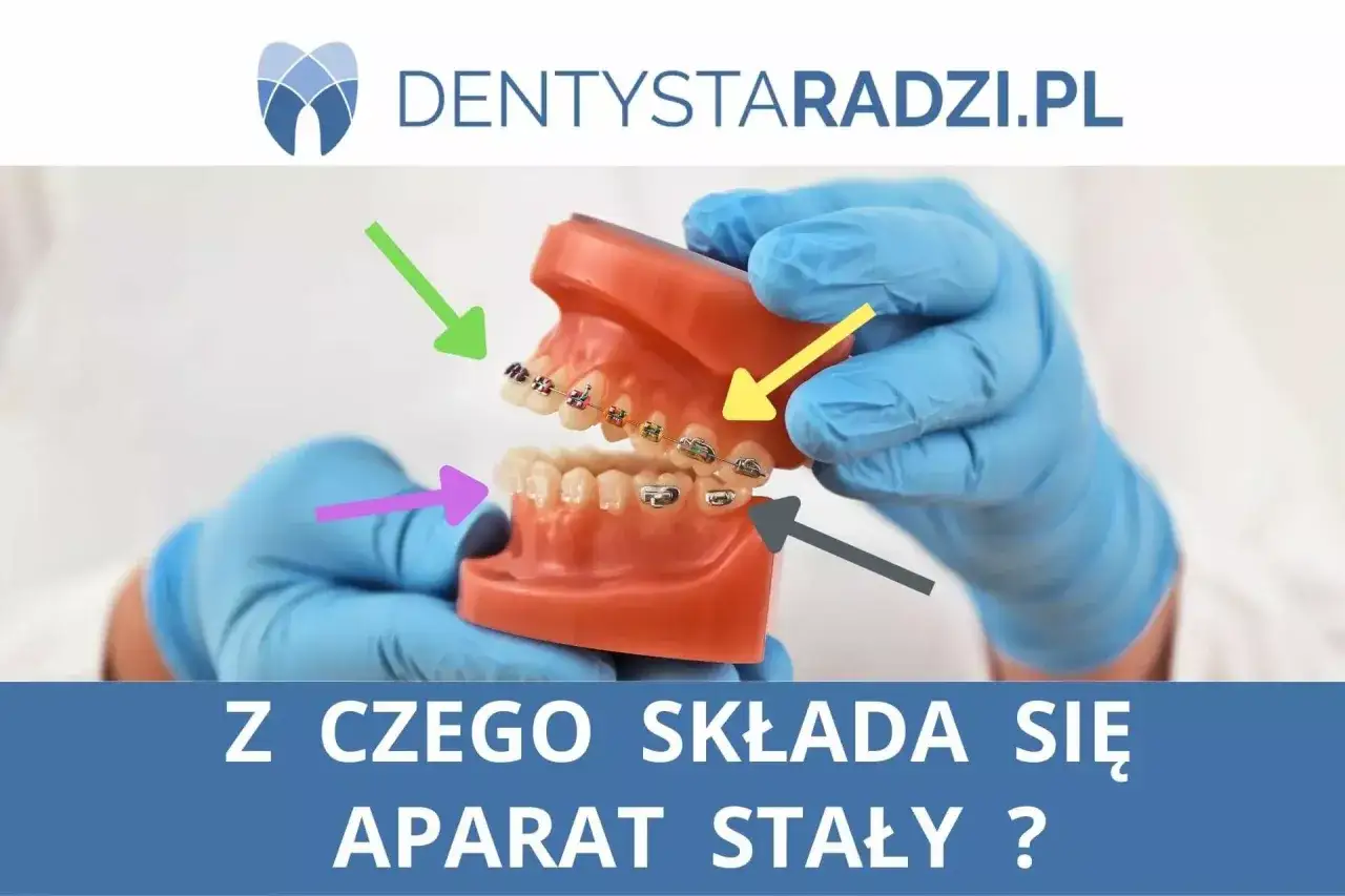 Model szczęki z kolorowymi strzałkami wskazującymi na pierścienie ortodontyczne na zębach.