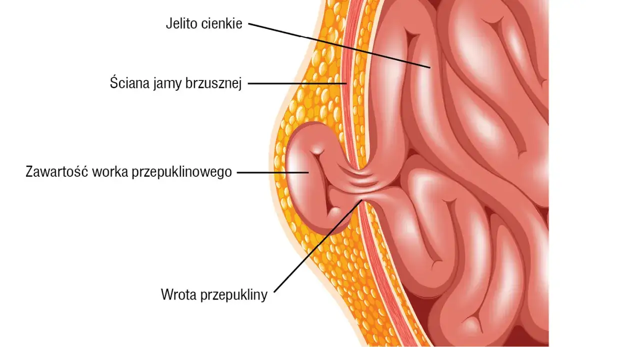 Przekrój ściany jamy brzusznej ukazujący jelito cienkie przechodzące przez wrotę przepukliny, tworząc zawartość worka przepuklinowego.