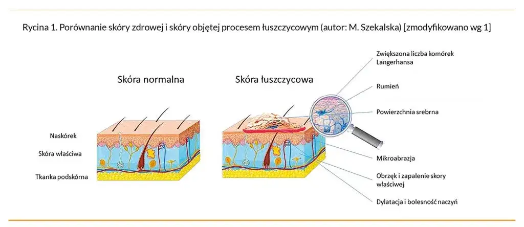 mechanizm działania leków biologicznych na łuszczycę