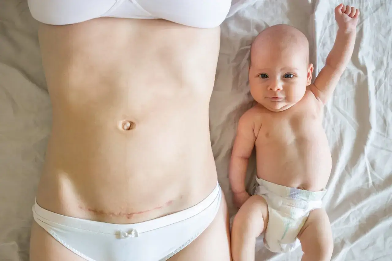 Ventre marqué par une cicatrice de césarienne, à côté d'un bébé. Un rappel de la maternité et de la rééducation périnée post-césarienne.