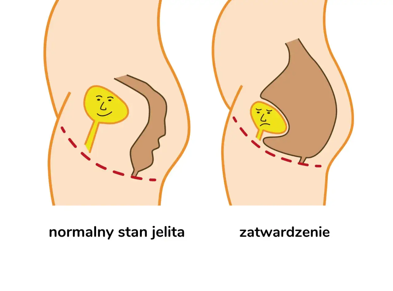 Ilustracja porównuje normalny stan jelita z zatwardzeniem u dziecka. Po lewej jelito jest luźne, po prawej zbite i trudne do przejścia.