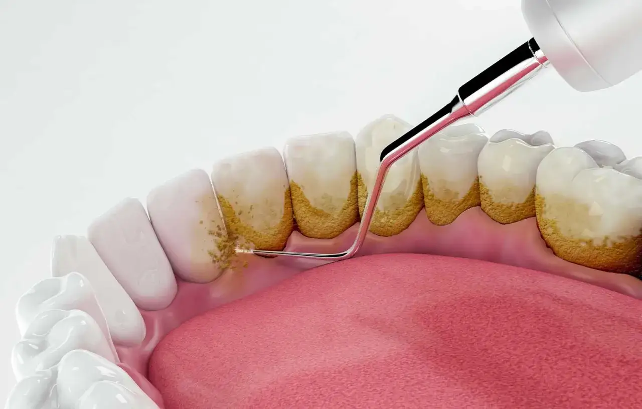 Strumento dentale rimuove il biofilm batterico dai denti, mostrando la placca accumulata sotto il bordo gengivale.