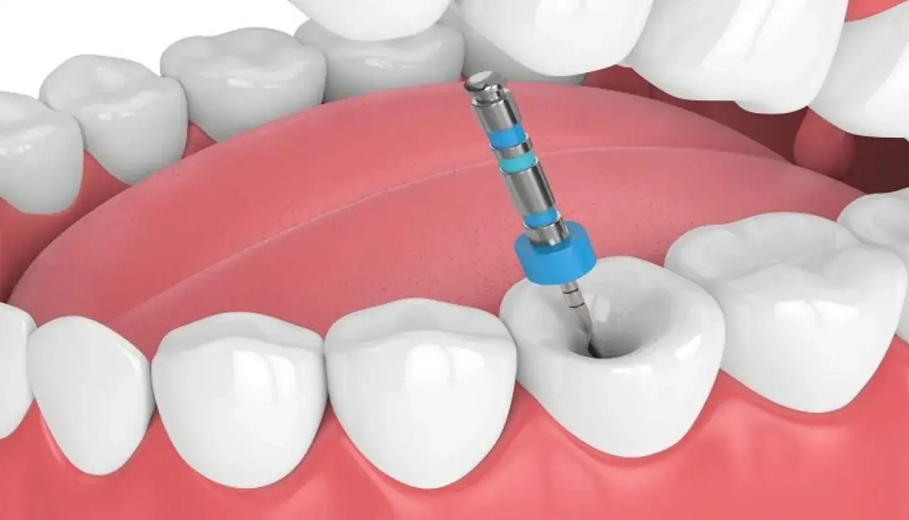 Instrumento dental limpia un diente afectado por una caries.
