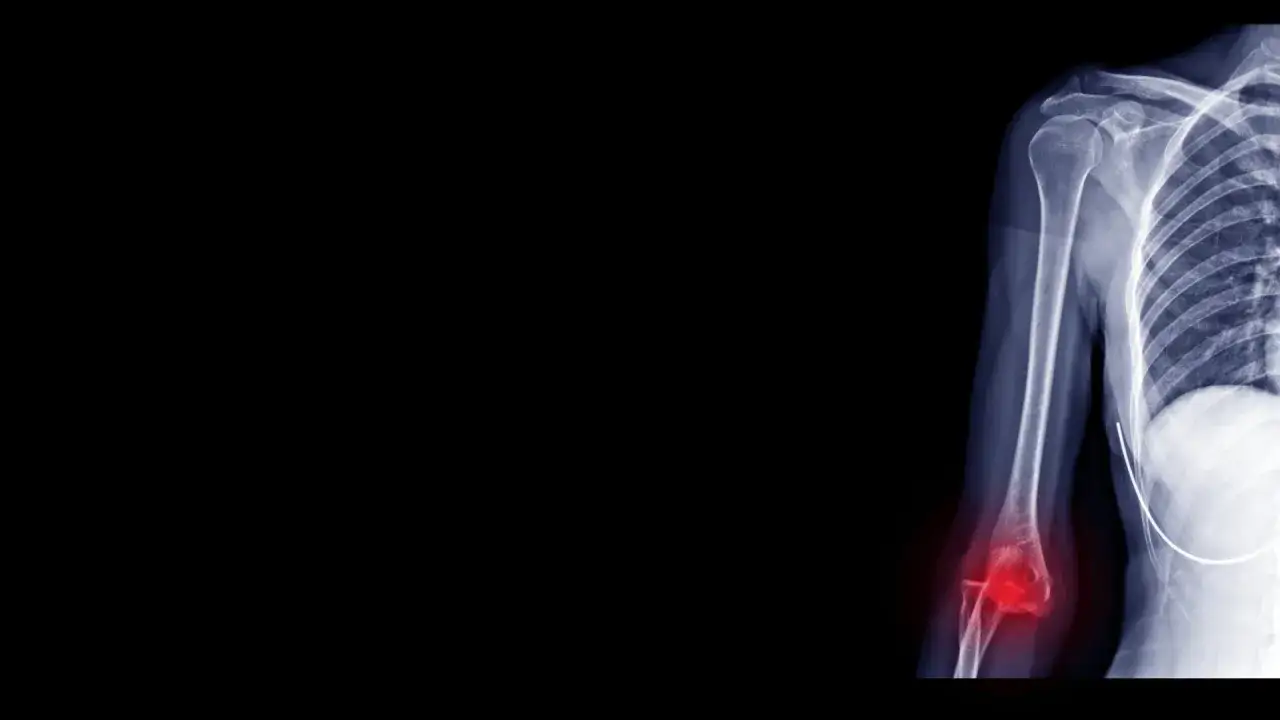 Röntgenbild zeigt einen ausgekugelten Ellenbogen mit roter Hervorhebung der verletzten Stelle.