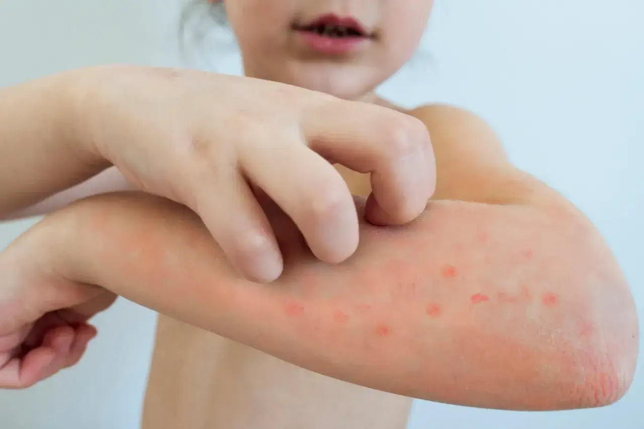 Bambino si gratta il braccio, mostrando le prime bolle di varicella. La pelle è arrossata e compaiono piccole pustole pruriginose.