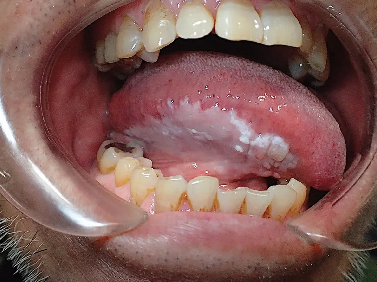 Leucoplachia sulla lingua, con aree biancastre che potrebbero indicare un tumore alla lingua.