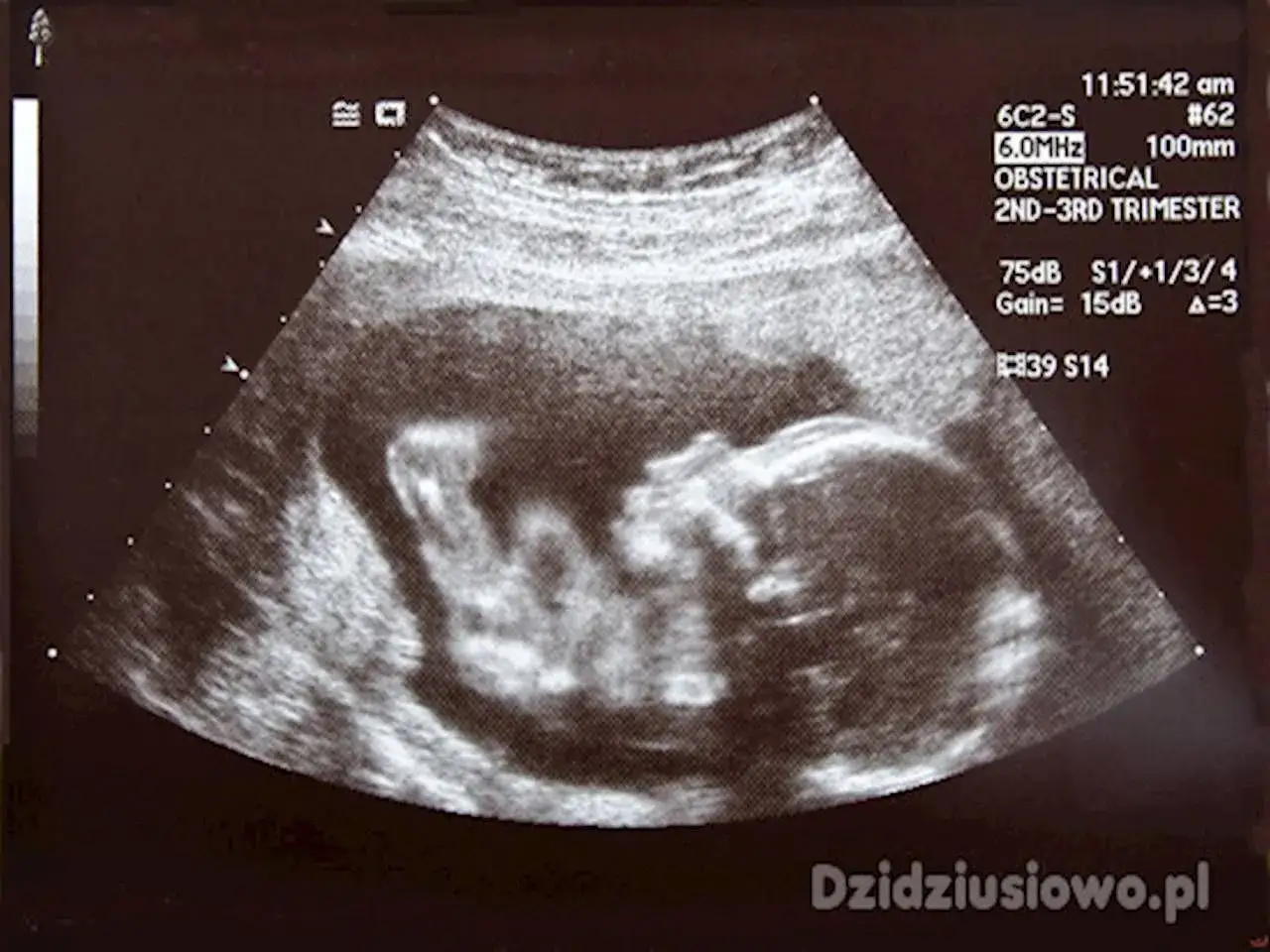 USG pokazuje dziecko w 7 miesiącu ciąży. Widać jego główkę i zarys ciała.