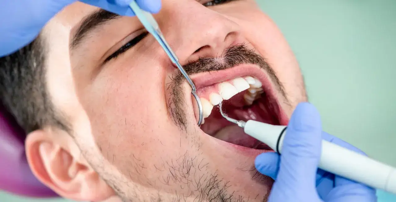 Dentysta usuwa kamień nazębny z zębów mężczyzny za pomocą ultradźwiękowego skalera.