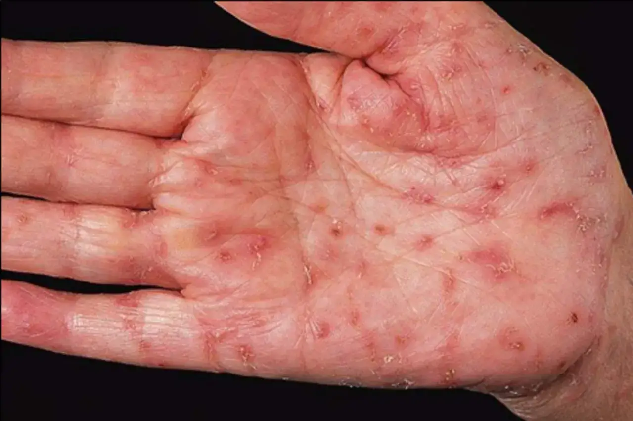 N&auml;rbild p&aring; en hand med utslag och rodnad som tyder p&aring; eksem p&aring; fingrarna.