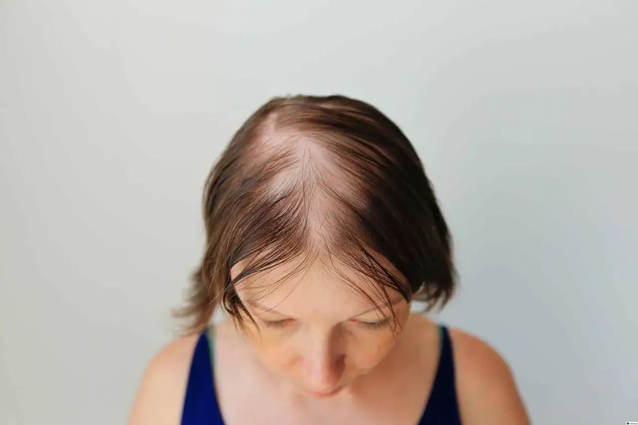 Kopf einer Frau mit sichtbaren Geheimratsecken und d&uuml;nner werdendem Haar, was auf diffusen Haarausfall hindeutet.