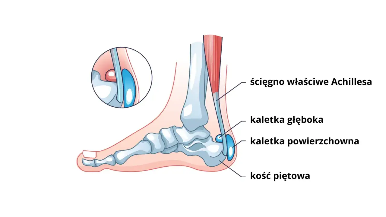 Anatomia pięty: ścięgno Achillesa, kaletka głęboka i powierzchowna. Zrozumienie tych struktur jest kluczowe dla leczenia zapalenia kaletki piętowej.