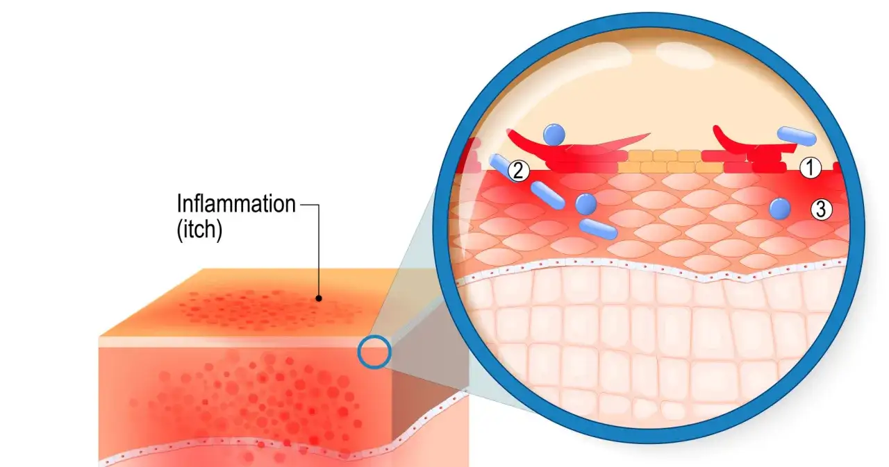 Ingrandimento della pelle che mostra infiammazione e prurito, il significato di atopica. Batteri e cellule immunitarie sono visibili.