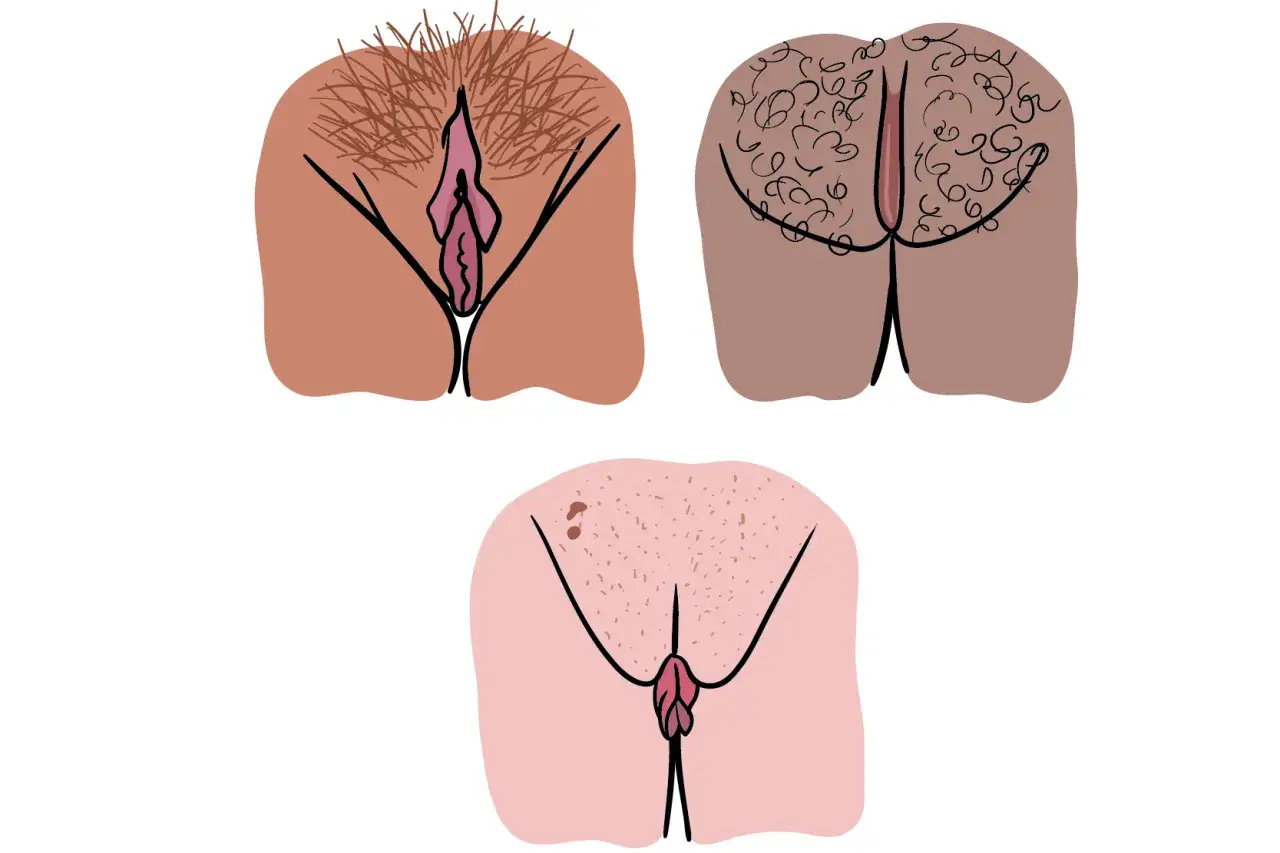 Illustration av tre olika vulvor. En med mycket h&aring;r, en med lockigt h&aring;r och en med lite h&aring;r och prickar. Ibland kan det lukta illa i underlivet genom byxorna.