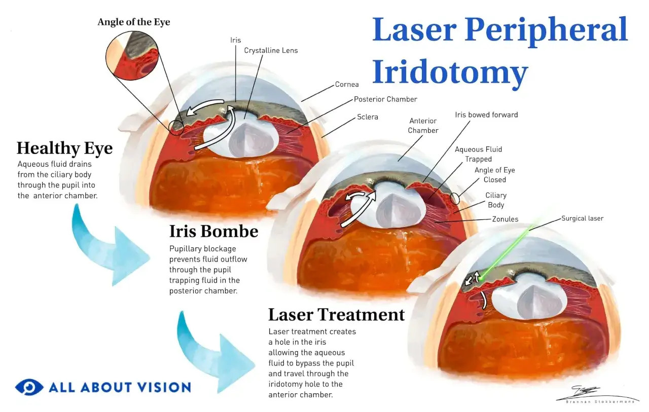 Laserowe leczenie jaskry: irydotomia obwodowa tworzy otw&oacute;r w tęcz&oacute;wce, umożliwiając odpływ płynu i obniżenie ciśnienia w oku.