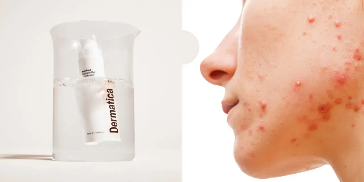 Dermatologiskt l&auml;ppbalsam i ett provr&ouml;r med vatten, bredvid en n&auml;rbild av en persons ansikte med hormonell akne.