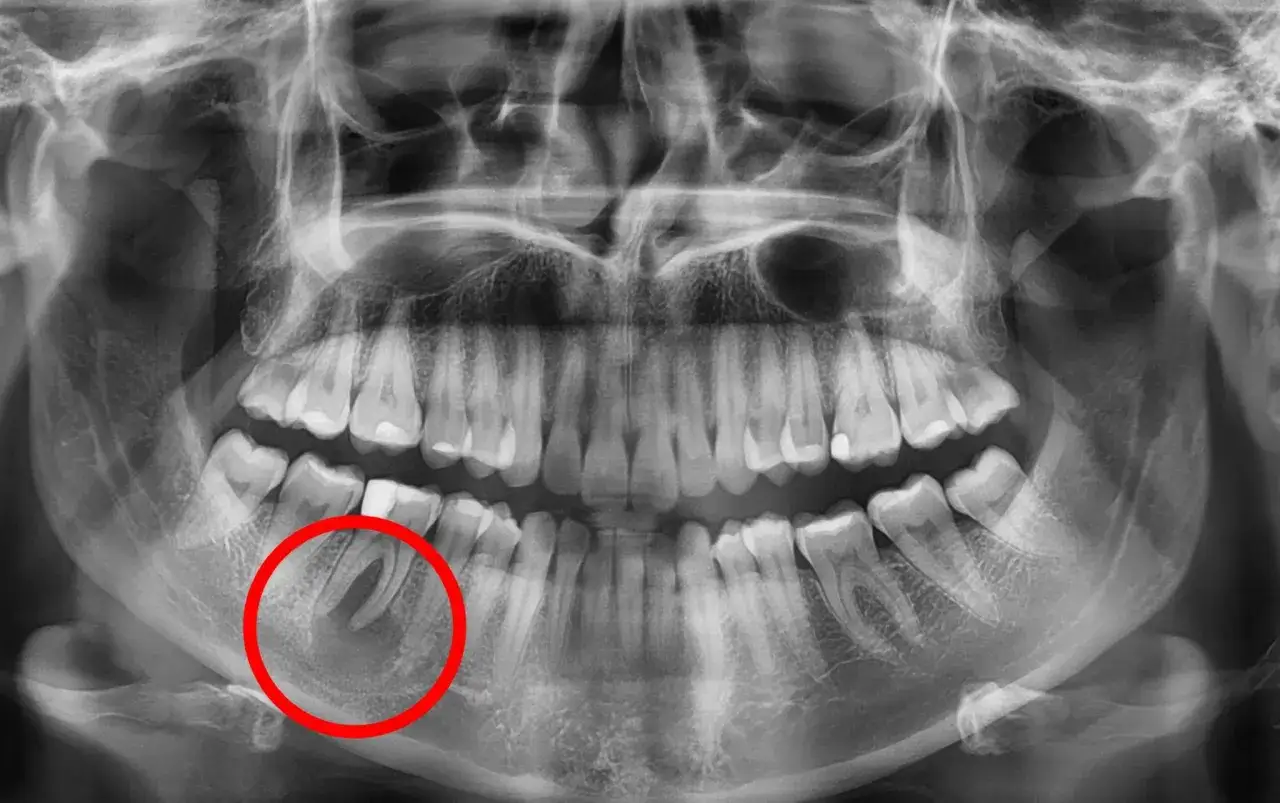 Rentgen szczęki z zaznaczoną torbielą przy zębie. Szukasz domowe sposoby na torbiel zęba? Konsultacja z dentystą jest kluczowa.