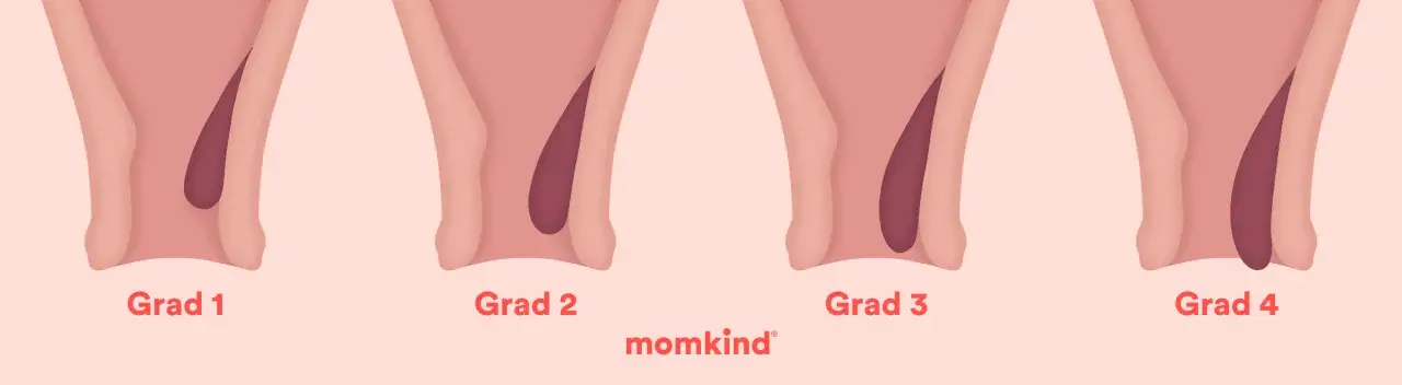 Illustration visar grader av hemorrojder, från grad 1 till 4. Vanligt vid graviditet.