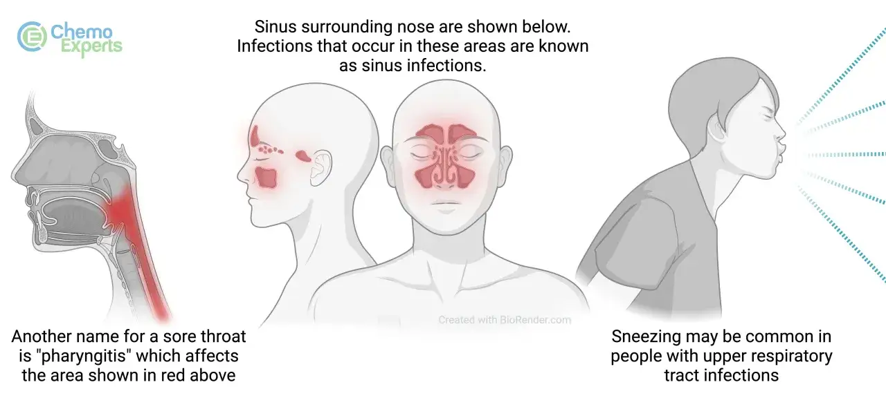 Illustration visar bihåleinflammation med röda områden i ansiktet. Antibiotika kan behövas vid svåra infektioner.