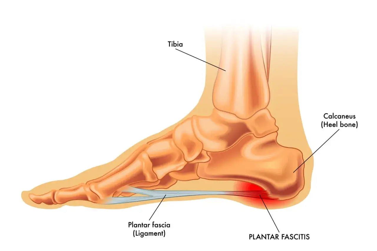 Anatomia stopy z zaznaczonym zapaleniem rozcięgna podeszwowego. Widoczna kość piętowa (calcaneus) i więzadło podeszwowe.