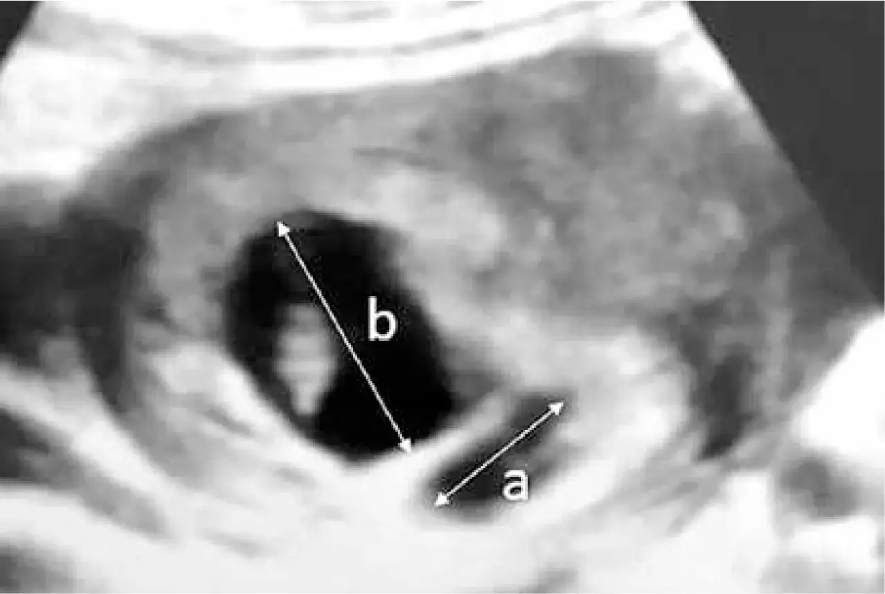 Ecograf&iacute;a muestra un hematoma subcori&oacute;nico, indicando c&oacute;mo se expulsa un hematoma en el embarazo.