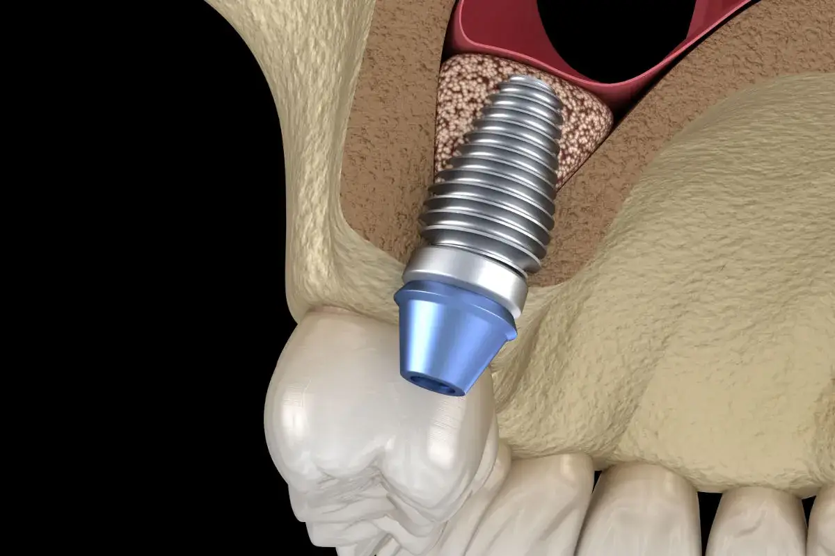 Implante dental en proceso de osteointegraci&oacute;n, ayudando a recuperar hueso dental y dar soporte a una pr&oacute;tesis.