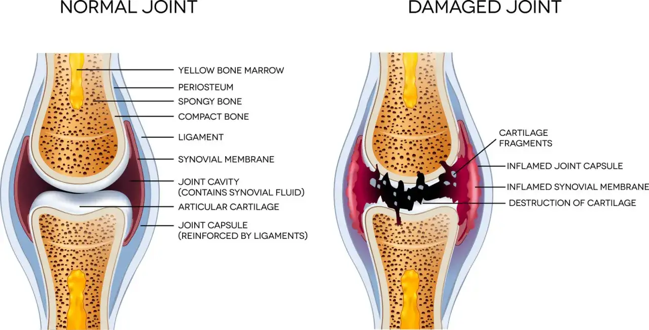 Comparaison d'une articulation saine et d'une articulation endommagée. Les effets secondaires de Flexadin chien peuvent être liés à l'inflammation articulaire.