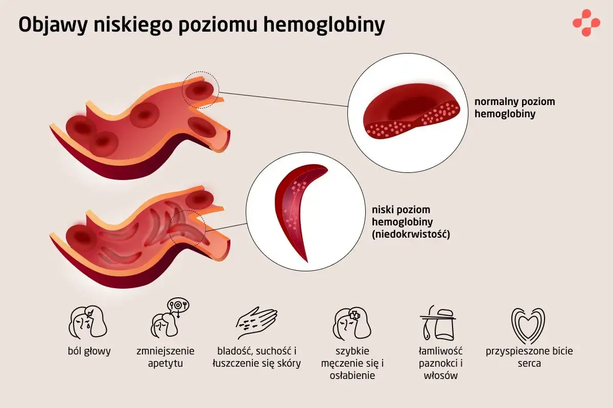 Ilustracja pokazuje, jak niski poziom hemoglobiny wpływa na kształt czerwonych krwinek, powodując objawy niedokrwistości. Norma hemoglobiny zapewnia prawidłowy transport tlenu.