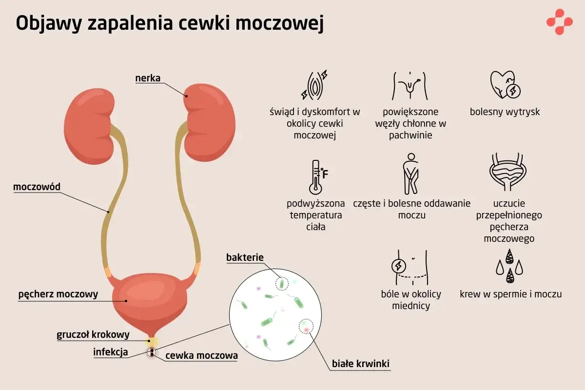 Objawy zapalenia cewki moczowej: świąd, ból, gorączka, krew w moczu. Ilustracja układu moczowego z zaznaczoną cewką.
