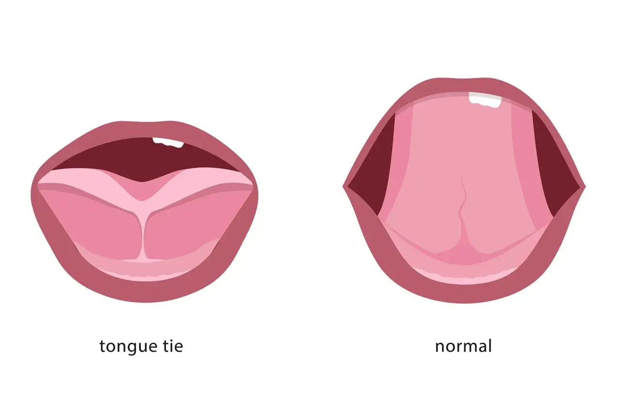 Anquiloglosia: la lengua est&aacute; unida al frenillo, limitando su movimiento. Comparaci&oacute;n con una lengua normal.