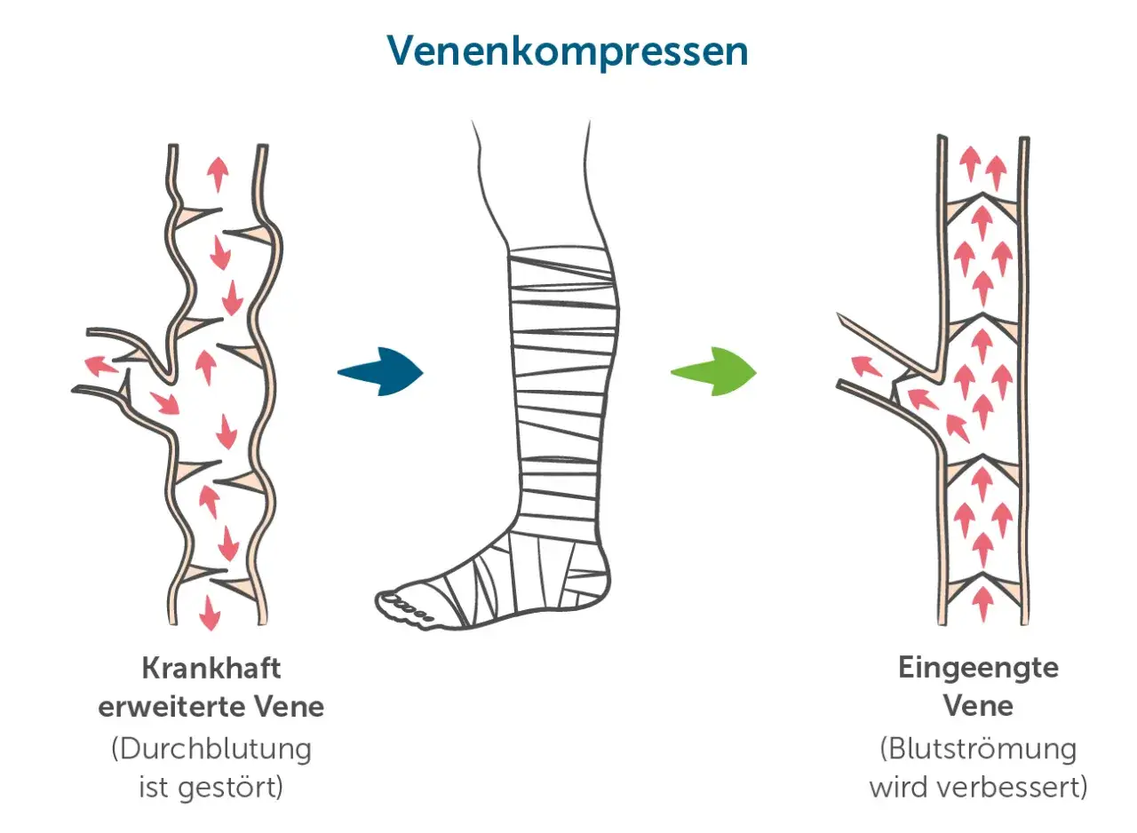 Venenkompression: Gestörte Durchblutung in erweiterter Vene wird durch Bandagieren verbessert. Eine thrombose spritze alternative.