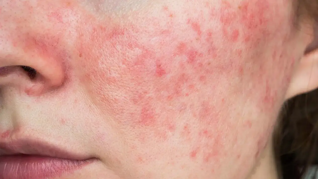 Primer plano de una mejilla con enrojecimiento y pequeños bultos, indicativo de rosacea leve.