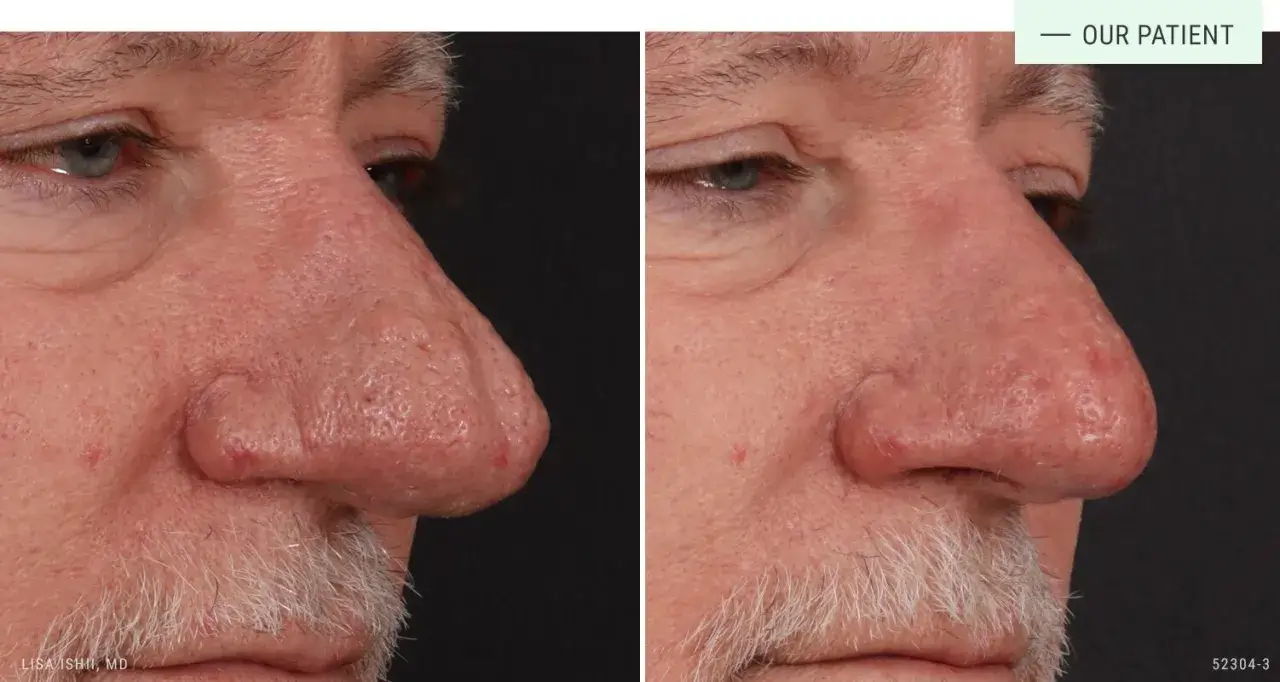 Före- och efterbilder visar en mans näsa före och efter rhinophyma behandling. Näsans rodnad och ojämnheter har minskat avsevärt.