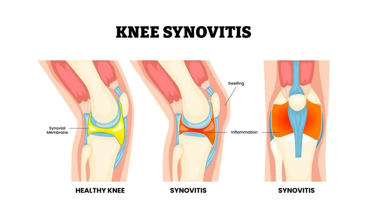 Ilustraci&oacute;n compara rodilla sana con sinovitis, mostrando inflamaci&oacute;n y hinchaz&oacute;n que pueden causar crujido rodilla.