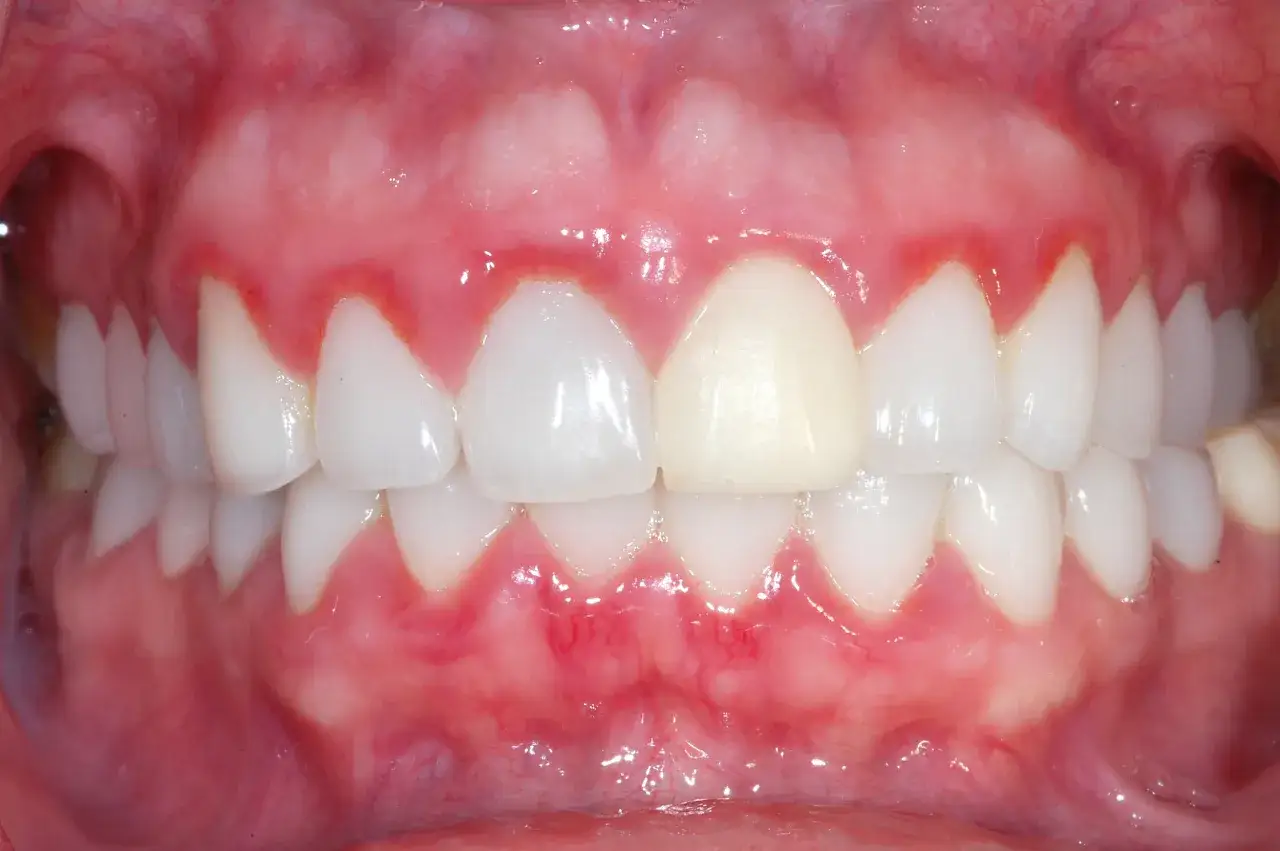Gengive gonfie e arrossate, segno di gengivite gravidica. Si notano i denti bianchi e sani, ma le gengive mostrano infiammazione.