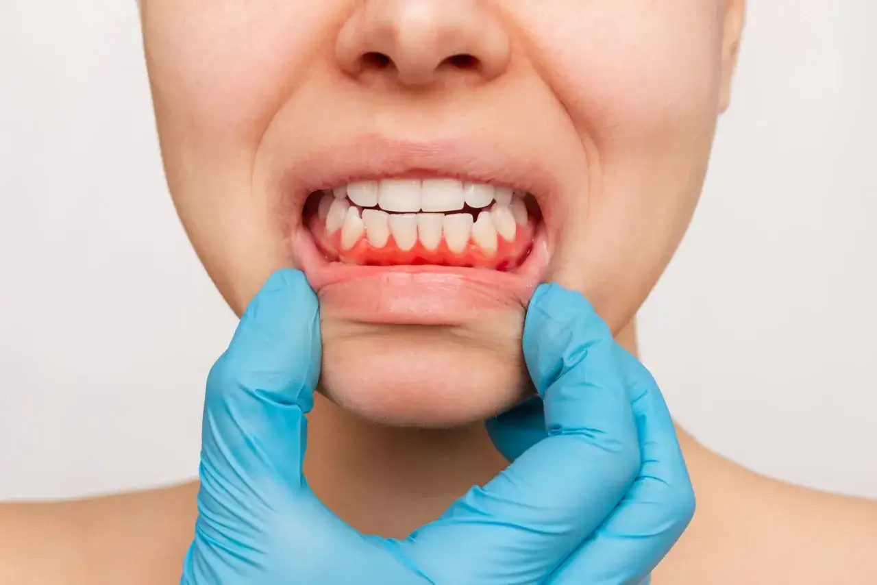 Enc&iacute;a inflamada y enrojecida, posible gingivitis por estr&eacute;s. Un guante azul examina la boca.