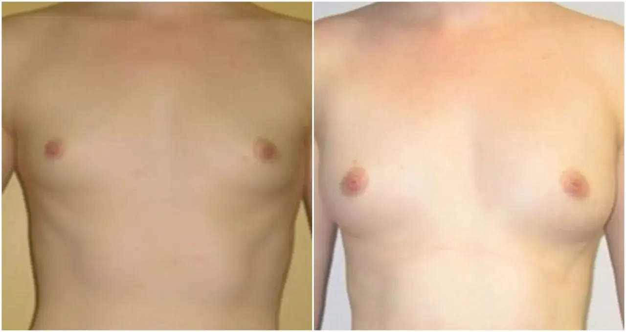 Przed i po lipotransferze biustu. Widoczna subtelna zmiana objętości i kształtu piersi, co pokazuje pozytywne lipotransfer biustu efekty.