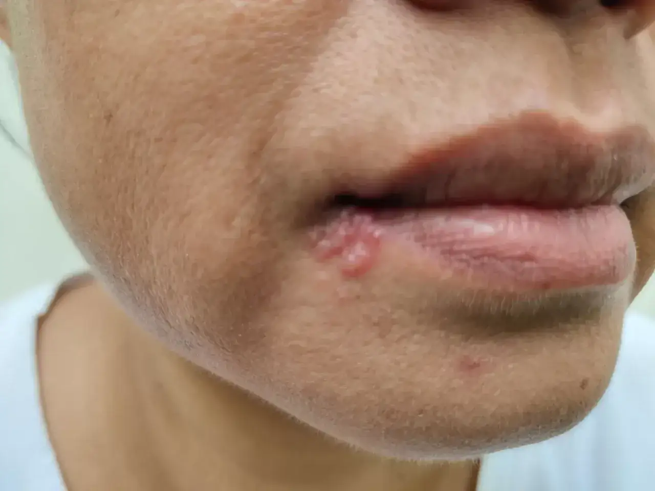 Primo piano del mento con lesioni tipiche di herpes labiale.